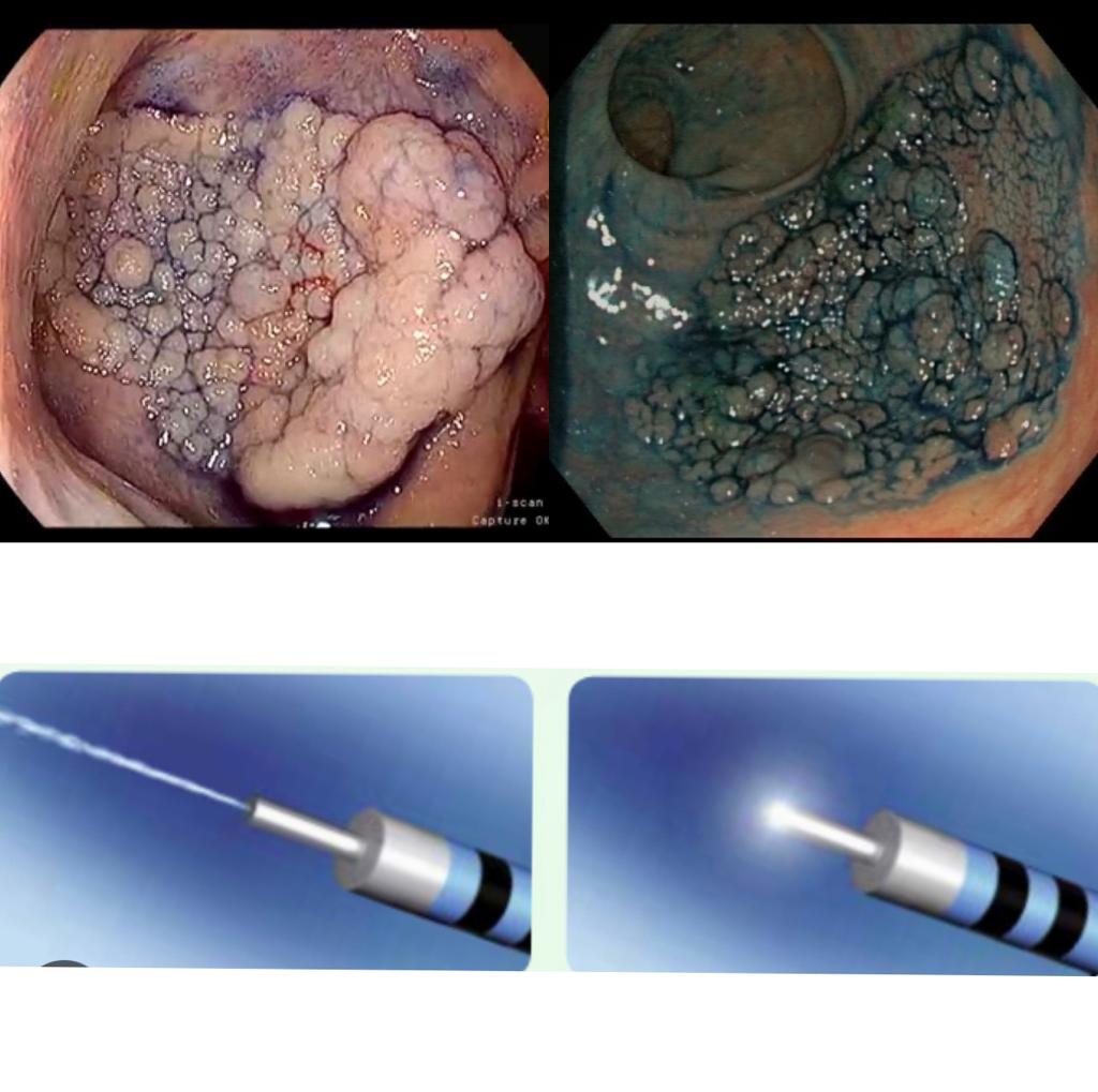 Curso de Técnica de avanzada endoscópica: Disección Submucosal Endoscópica (DSE) - Equipo F